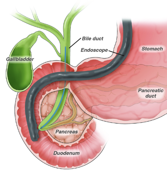 ERCP Explained: Why It’s Done and What to Expect